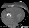 Aortic Stenosis